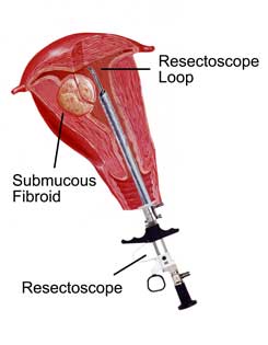 resectoscope2.jpg